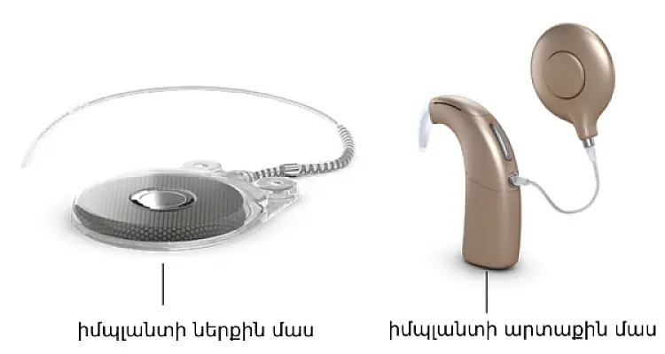 Երևանում խխունջի իմպլանտով ևս երկու մարդու լսողություն են վերականգնել